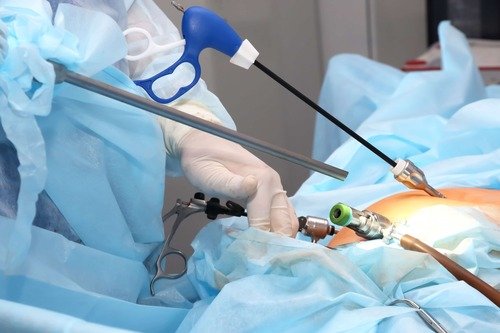Laparoscopy For Ectopic Pregnancy