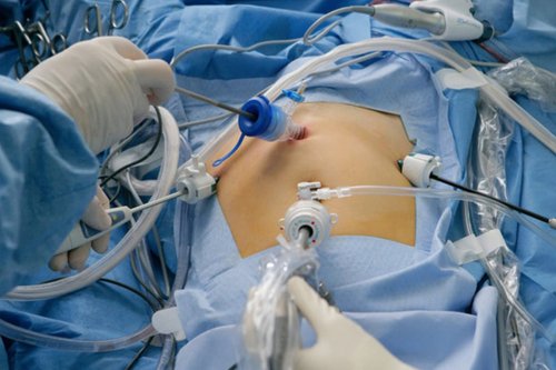 Laparoscopic Myomectomy